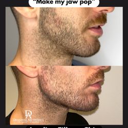 Designer Aesthetics by Dr Jarrett Schanzer - Make your jawline pop Natural, sculpted definition with jawline filler in Miami. Book at DoctorJarrett.com or text 954-935-4488