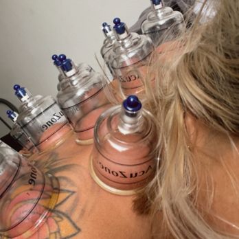 Ace Chiropractic Clinic - Cupping - Chiropractors Near Me - Glendale, California Ace Chiropractic Clinic - Cupping - Chiropractors Near Me - Glendale, California