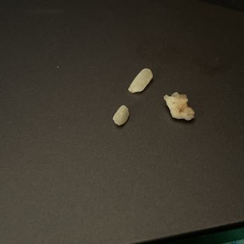 Shake Shack Kentlands - Bone fragments, varying in sizes. One was found in each of the burgers I've eaten so far. - Burgers Near Me - Gaithersburg, Maryland Shake Shack Kentlands - Bone fragments, varying in sizes. One was found in each of the burgers I've eaten so far. - Burgers Near Me - Gaithersburg, Maryland