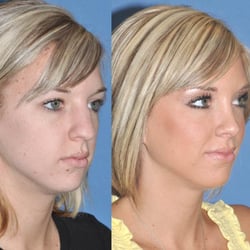 John A Vartanian, MD, FACS - Natural appearing rhinoplasty result, in harmony with the patient's facial features by Dr. Vartanian.