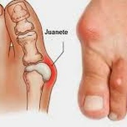 Dr Arceo Traumatologo Ortopedista Tijuana - Hallux Valgus