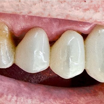 True View Dental - Look at the holes and huge black triangles!! - General Dentistry Near Me - Naples, Florida True View Dental - Look at the holes and huge black triangles!! - General Dentistry Near Me - Naples, Florida