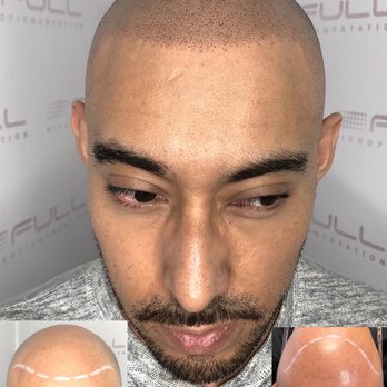 Full Micropigmentation - Hair Loss Centers Near Me - Las Vegas, Nevada Full Micropigmentation - Hair Loss Centers Near Me - Las Vegas, Nevada