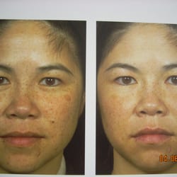 Corona Laser Center