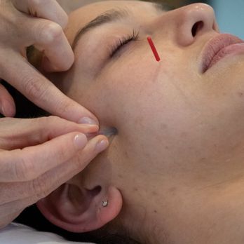 Revive + Root - Facial acupuncture stimulates collagen and helps reduce fine lines and wrinkles. - Acupuncture Near Me - New York, New York Revive + Root - Facial acupuncture stimulates collagen and helps reduce fine lines and wrinkles. - Acupuncture Near Me - New York, New York