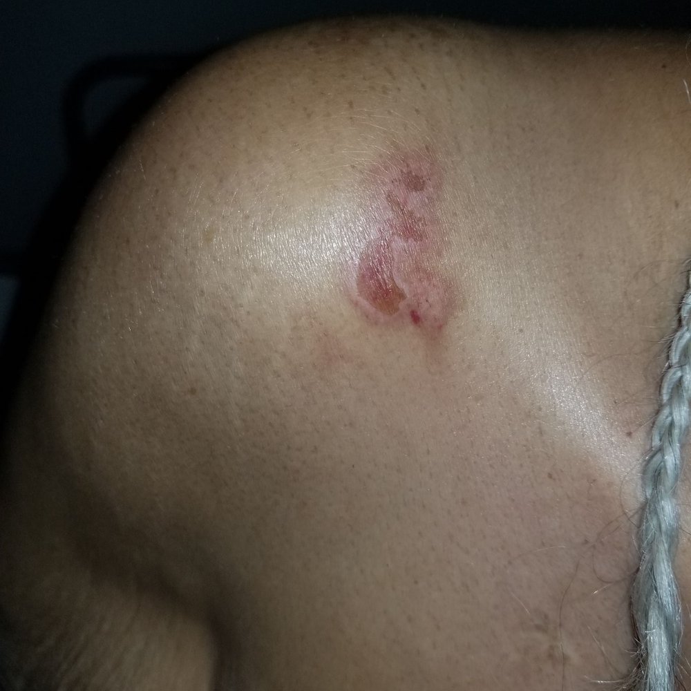 McClure Post Acute - Abrasion to her R shoulder. - Rehabilitation Center Near Me - Oakland, California McClure Post Acute - Abrasion to her R shoulder. - Rehabilitation Center Near Me - Oakland, California