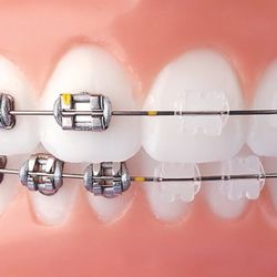 El Camino Dental - Free Consultation for Braces! Call us now!
(424) 297-0513