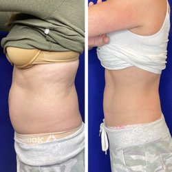Emsculpt + Emtone before and after!