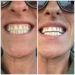 DaVinci Teeth Whitening of Fort Collins - Before and after!