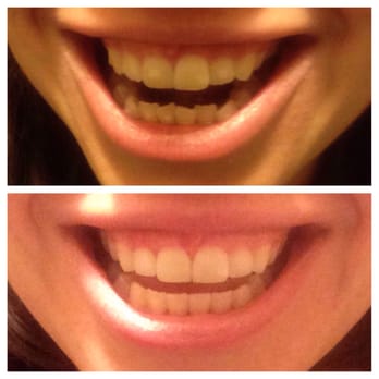 Memorial Park Dental - Before and after of my Invisalign results. These are pics I took at home. - General Dentistry Near Me - Houston, Texas Memorial Park Dental - Before and after of my Invisalign results. These are pics I took at home. - General Dentistry Near Me - Houston, Texas