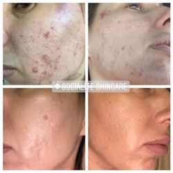 Socialite Skincare - Peels make everything better.