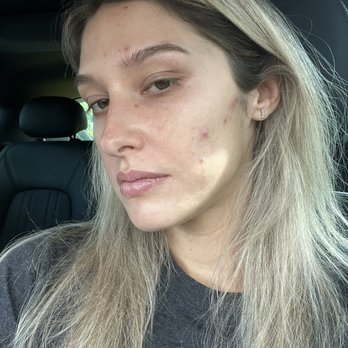 Schweiger Dermatology- Central Boca Raton formerly Clearlyderm - Before seeing dr.Conrad - Dermatologists Near Me - Boca Raton, Florida Schweiger Dermatology- Central Boca Raton formerly Clearlyderm - Before seeing dr.Conrad - Dermatologists Near Me - Boca Raton, Florida
