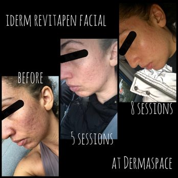 Dermaspace - Once a week for 5 sessions then the last 3 were every other week. She did Iderm Revitapen w/LED and used our home products. Results vary. - Skin Care Near Me - Seattle, Washington Dermaspace - Once a week for 5 sessions then the last 3 were every other week. She did Iderm Revitapen w/LED and used our home products. Results vary. - Skin Care Near Me - Seattle, Washington