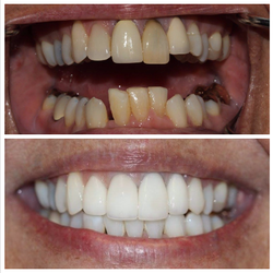 Emigh Dental Care - Invisalign, whitening, and porcelain crowns