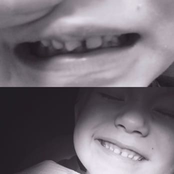 Dentartistry - Before & After - they fixed my little one's front tooth! - General Dentistry Near Me - Yucaipa, California