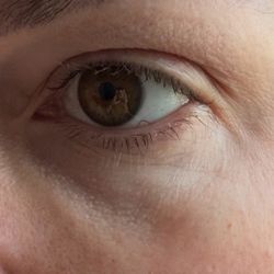 Unified Health - Bad under eye filler showing visible dents and bumps