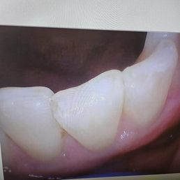 cavities have been filled cavities have been filled