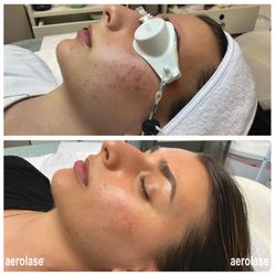 Trend Sassy Laser & Med Spa - Aerolase acne treatment results: reduced breakouts, calmer skin, and a clearer, healthier complexion.
