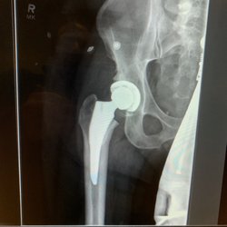 Mitts Kevin G MD - Actual hip implant.