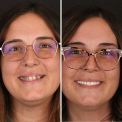 Britely Dentures + Implants Studio - Final result of full mouth dental implants!