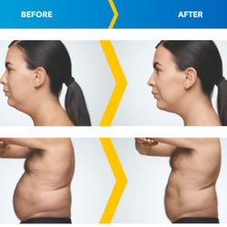 CosMedics - Is Coolsculpting right for you?