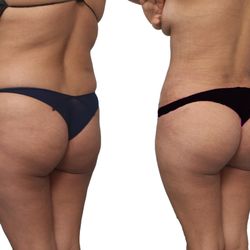 Pelosi Medical Center - BBL with Lipo 360. Includes lipo of front, back and sides.