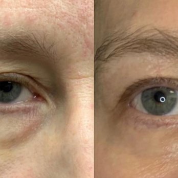 Liv Beautiful - Before & after fibroblast upper & lower eyes. - Medical Spas Near Me - Las Vegas, Nevada Liv Beautiful - Before & after fibroblast upper & lower eyes. - Medical Spas Near Me - Las Vegas, Nevada