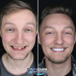 Secure Dentures and Implants - A new smile in one day!