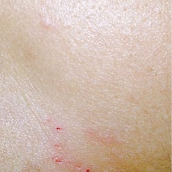 Cuts above lips...