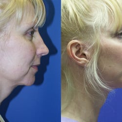 Sadi Erfani, MD - Facelift Procedure - Before & After.