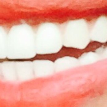 Temple Dental Trails - Front crowns: perfect! - General Dentistry Near Me - Temple, Texas
