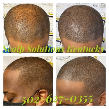 Scalp Solutions Kentucky - Scalp Micropigmentation (SMP) Before & After - Hair Loss Centers Near Me - Louisville, Kentucky Scalp Solutions Kentucky - Scalp Micropigmentation (SMP) Before & After - Hair Loss Centers Near Me - Louisville, Kentucky