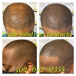 Scalp Solutions Kentucky - Scalp Micropigmentation (SMP) Before & After