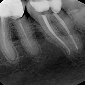 Midtown Endodontist NYC - Root canal of tooth on the right - Endodontists Near Me - New York, New York Midtown Endodontist NYC - Root canal of tooth on the right - Endodontists Near Me - New York, New York