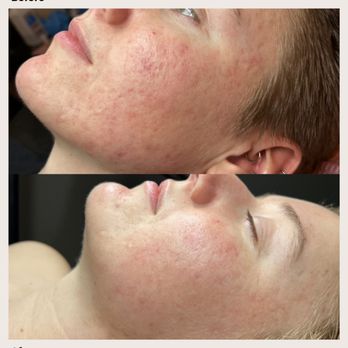 Skottē Esthetics - Microneedling results from 3 sessions - Skin Care Near Me - Corvallis, Oregon