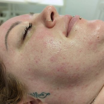 Serene Sage Spa - Dermaplaning - Skin Care Near Me - Lacey, Washington