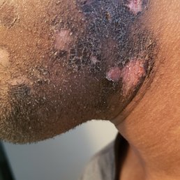 2nd degree burns from laser hair removal. 2nd degree burns from laser hair removal.