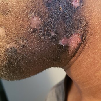 New Skin Solutions - 2nd degree burns from laser hair removal. - Body Contouring Near Me - Rancho, California New Skin Solutions - 2nd degree burns from laser hair removal. - Body Contouring Near Me - Rancho, California