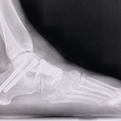 Texas Foot and Ankle Consultants - 2 screws in my heal, also shows where I now have an arch where I used to stand flat footed.