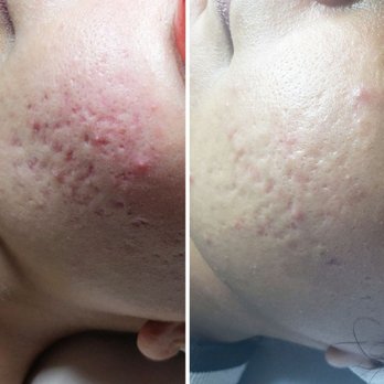 True Care Esthetics - Before and after with consistent corrective treatments - Skin Care Near Me - Chino Hills, California True Care Esthetics - Before and after with consistent corrective treatments - Skin Care Near Me - Chino Hills, California