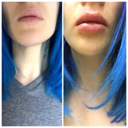 Kirby Dermatology - Lovely Brittany before and right after.