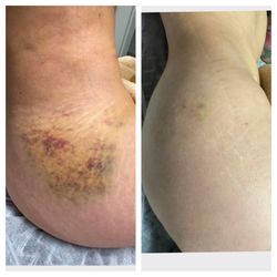 Euro Charm Skincare and Body Clinic - About a week of treatments before and after for bruising and swelling .