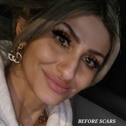 Syracuse Plastic Surgery Skin & Wellness - My face before. I wish I never went to S.P.S.