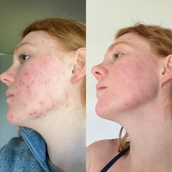 Ernest Bloom, MD - 1 week before seeing Dr. Bloom - 4 months after first visit