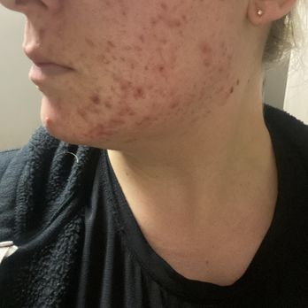 Facial Kneads By Mari - Before - Skin Care Near Me - San Jose, California