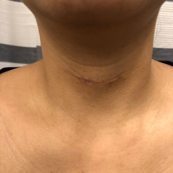 Austin Thyroid & Parathyroid Surgeons - 3 weeks post surgery - Surgeons Near Me - Austin, Texas