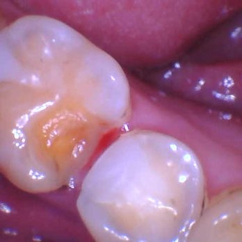 Bensonhurst Endodontics & Dental Implants - Endodontists Near Me - Brooklyn, New York Bensonhurst Endodontics & Dental Implants - Endodontists Near Me - Brooklyn, New York