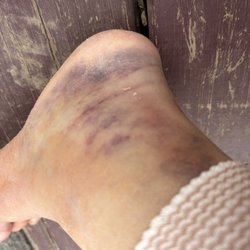 Boston Sports & Shoulder Center - My heel bruised beyond recognition. I'm supposed to get a machine to deal with bruising. Never heard back.