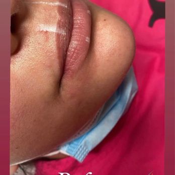 Casa Aesthetics & Spa - before lippies - Skin Care Near Me - Sunset Park, New York