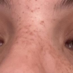 Redness and burns on eyelids (centers) Redness and burns on eyelids (centers)